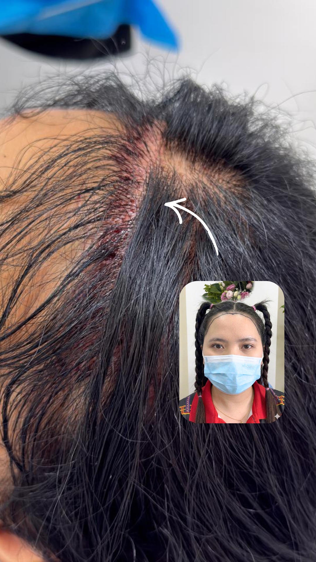 After Long Hair FUE Transplant