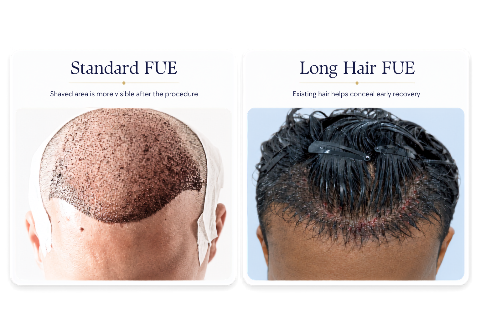 Different Between standard FUE and Long Hair FUE
