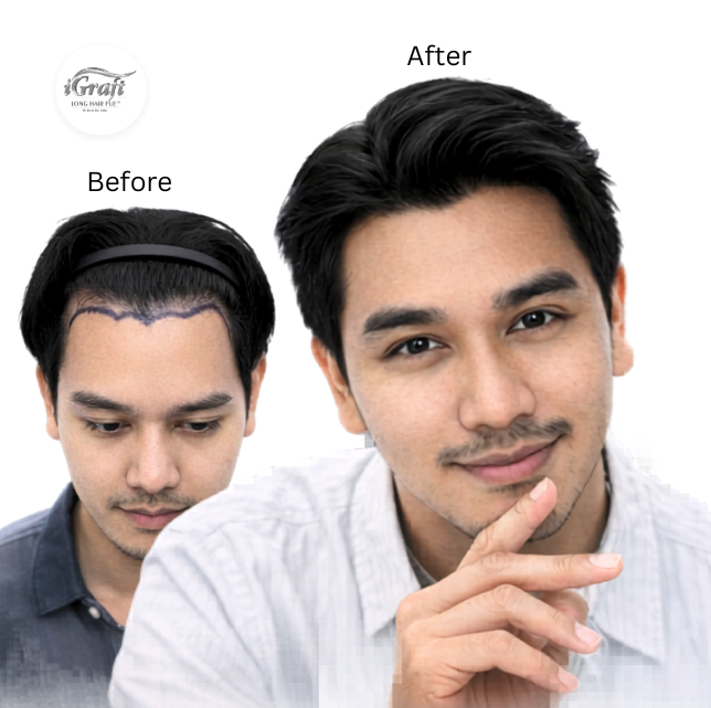 iGraft Long Hair FUE - Immediate result