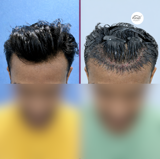 iGraft Long Hair FUE - Immediate resutl