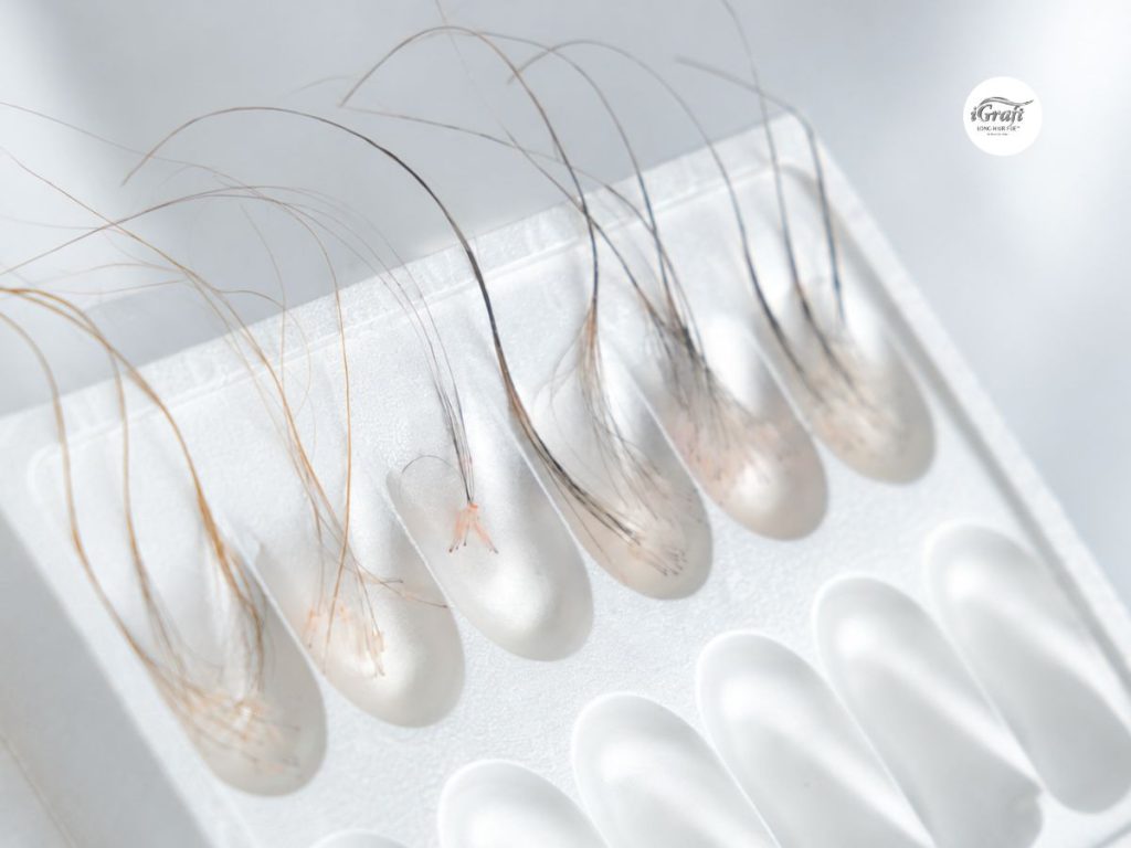 The Ultimate Guide to iGraft Long Hair FUE Malaysia - Long Hair Grafts