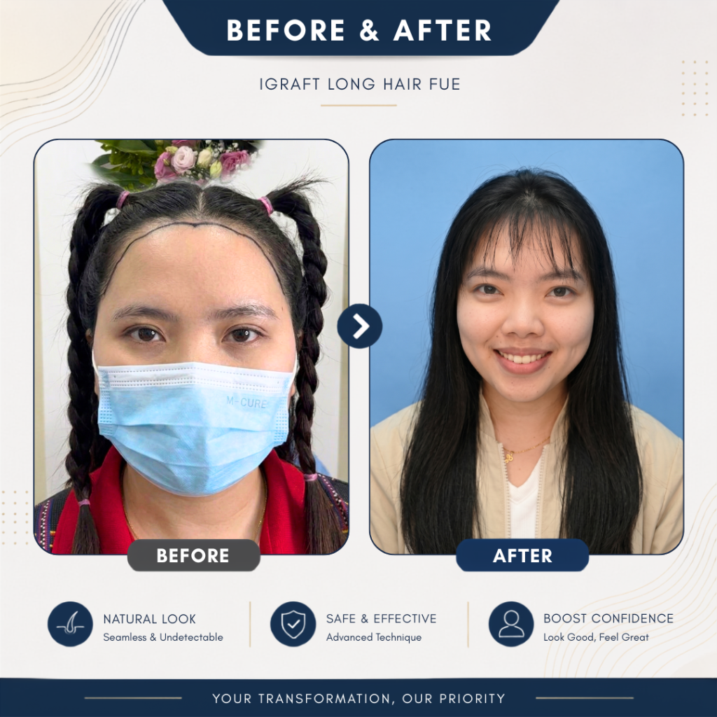 iGraft long hair fue Before after 1